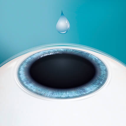 Step 1: Korrektur Ihrer Fehlsichtigkeit mittels ICL Linse Step 1: Korrektur Ihrer Fehlsichtigkeit mittels ICL Linse