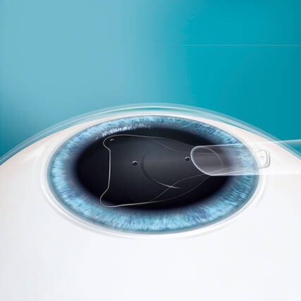 Step 2: Korrektur Ihrer Fehlsichtigkeit mittels ICL Linse Step 2: Korrektur Ihrer Fehlsichtigkeit mittels ICL Linse
