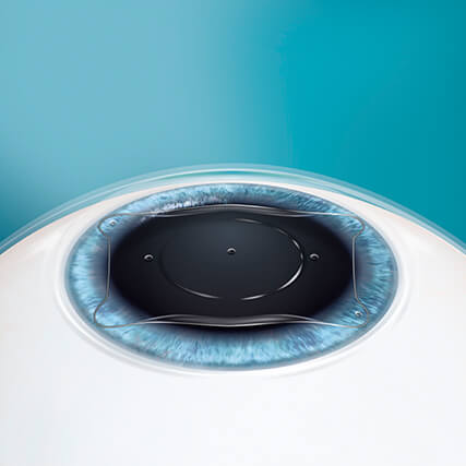 Step 3: Korrektur Ihrer Fehlsichtigkeit mittels ICL Linse Step 3: Korrektur Ihrer Fehlsichtigkeit mittels ICL Linse