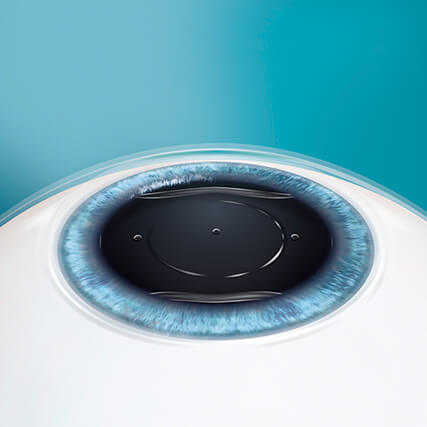 Step 4: Korrektur Ihrer Fehlsichtigkeit mittels ICL Linse Step 4: Korrektur Ihrer Fehlsichtigkeit mittels ICL Linse