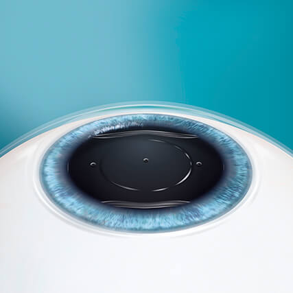 Step 5: Korrektur Ihrer Fehlsichtigkeit mittels ICL Linse Step 5: Korrektur Ihrer Fehlsichtigkeit mittels ICL Linse