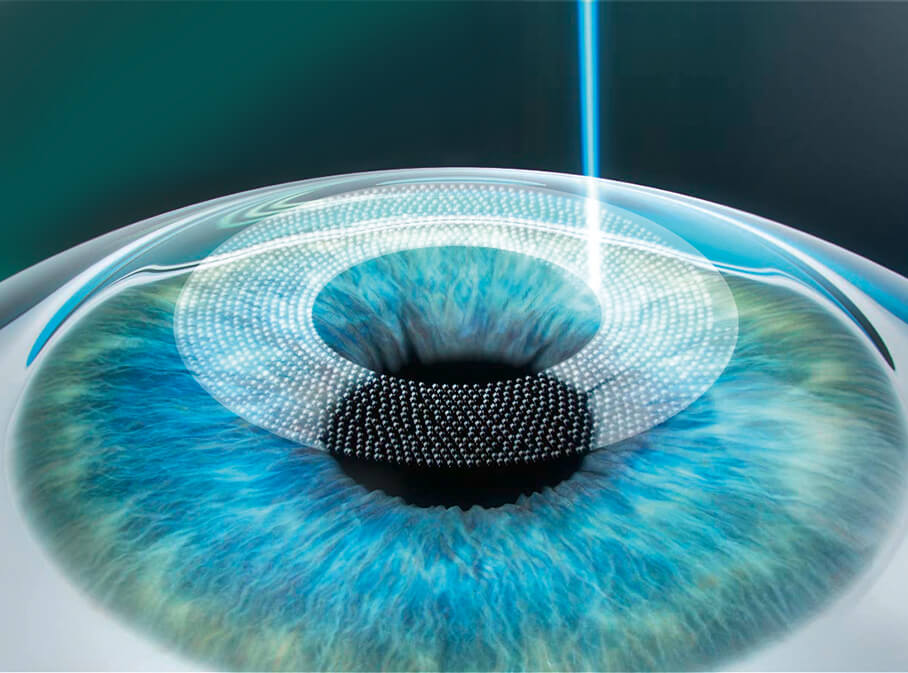 Step 1: Korrektur Ihrer Fehlsichtigkeit mittels Femto-Lasik Step 1: Korrektur Ihrer Fehlsichtigkeit mittels Femto-Lasik
