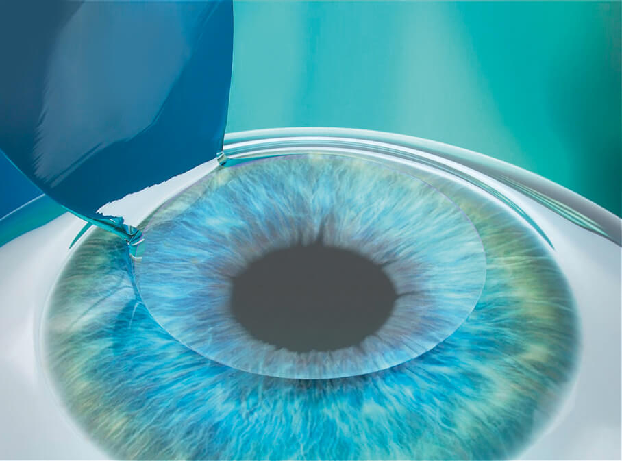 Step 2: Korrektur Ihrer Fehlsichtigkeit mittels Femto-Lasik Step 2: Korrektur Ihrer Fehlsichtigkeit mittels Femto-Lasik