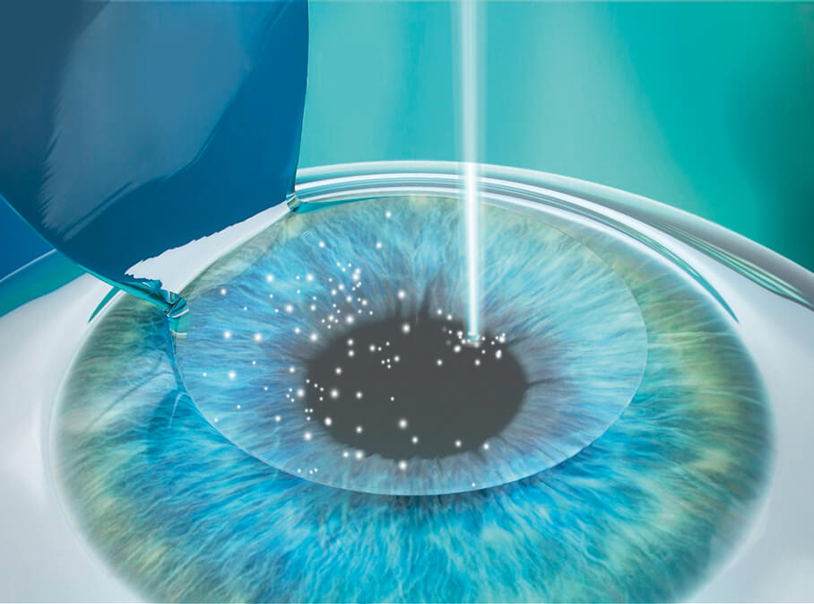 Step 3: Korrektur Ihrer Fehlsichtigkeit mittels Femto-Lasik Step 3: Korrektur Ihrer Fehlsichtigkeit mittels Femto-Lasik