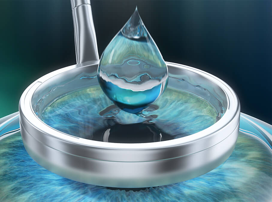 Step 1: Korrektur Ihrer Fehlsichtigkeit mittels LASEK/PRK Step 1: Korrektur Ihrer Fehlsichtigkeit mittels LASEK/PRK