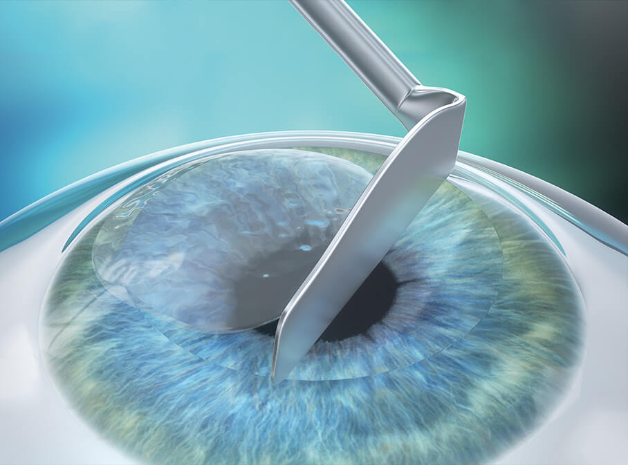 Step 2: Korrektur Ihrer Fehlsichtigkeit mittels LASEK/PRK Step 2: Korrektur Ihrer Fehlsichtigkeit mittels LASEK/PRK