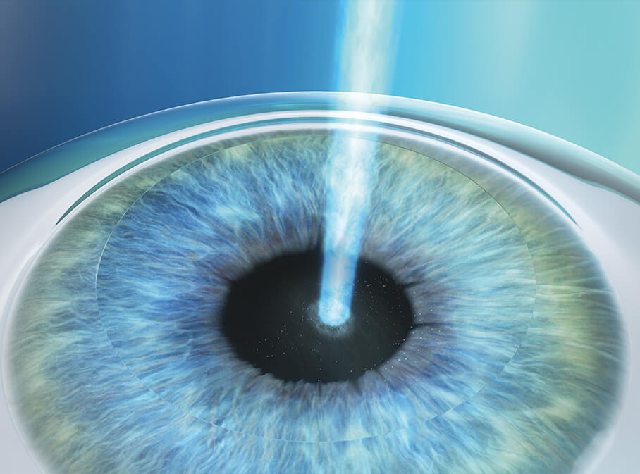 Step 3: Korrektur Ihrer Fehlsichtigkeit mittels LASEK/PRK Step 3: Korrektur Ihrer Fehlsichtigkeit mittels LASEK/PRK