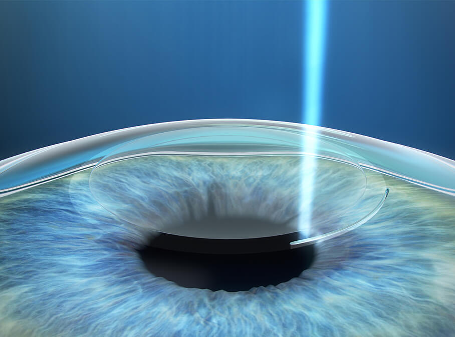 Step 1: Korrektur Ihrer Fehlsichtigkeit mittels ReLEx SMILE Step 1: Korrektur Ihrer Fehlsichtigkeit mittels ReLEx SMILE