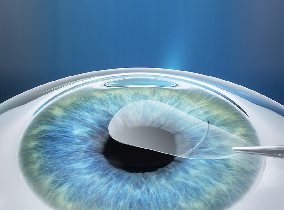 Step 2: Korrektur Ihrer Fehlsichtigkeit mittels ReLEx SMILE Step 2: Korrektur Ihrer Fehlsichtigkeit mittels ReLEx SMILE